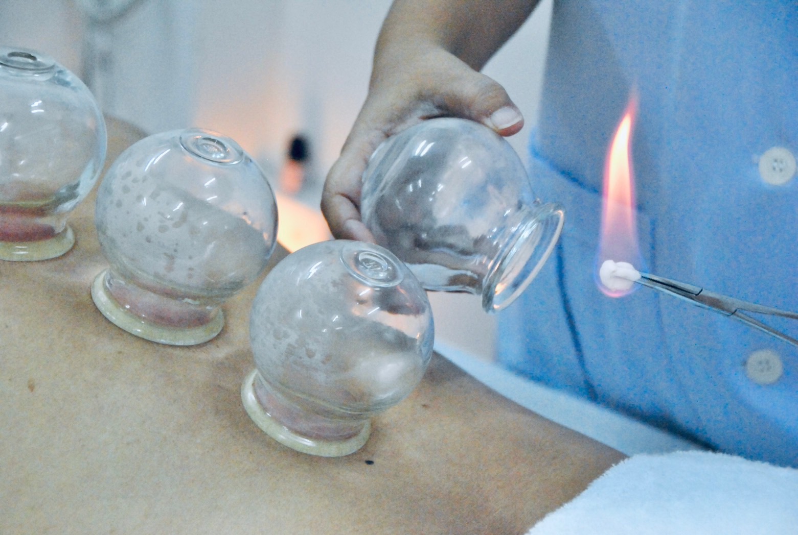 Pattaya Acupuncture Clinic, Rompho, Pattaya, cupping