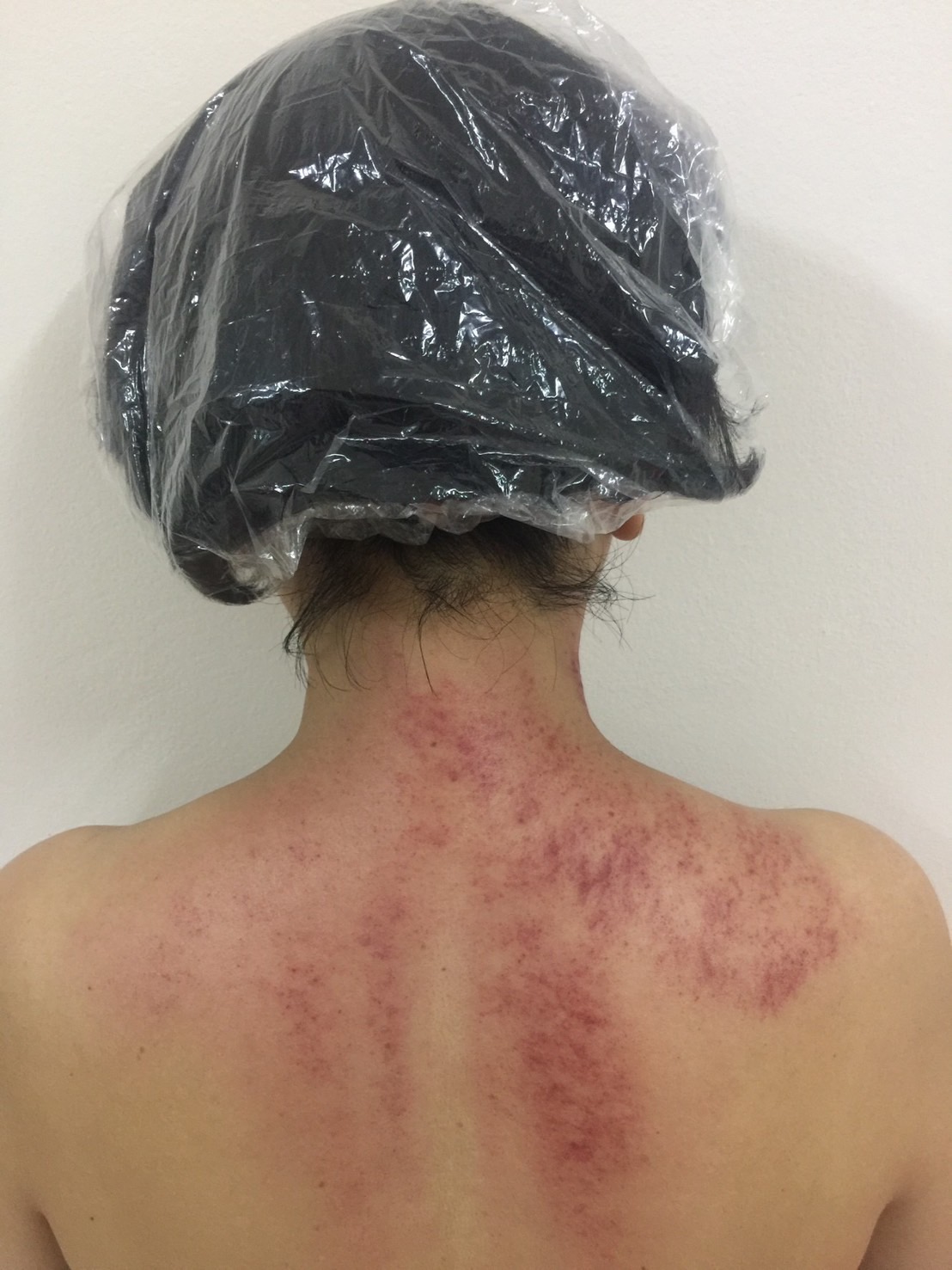 Pattaya Acupuncture Clinic, Rompho, Pattaya, guasa